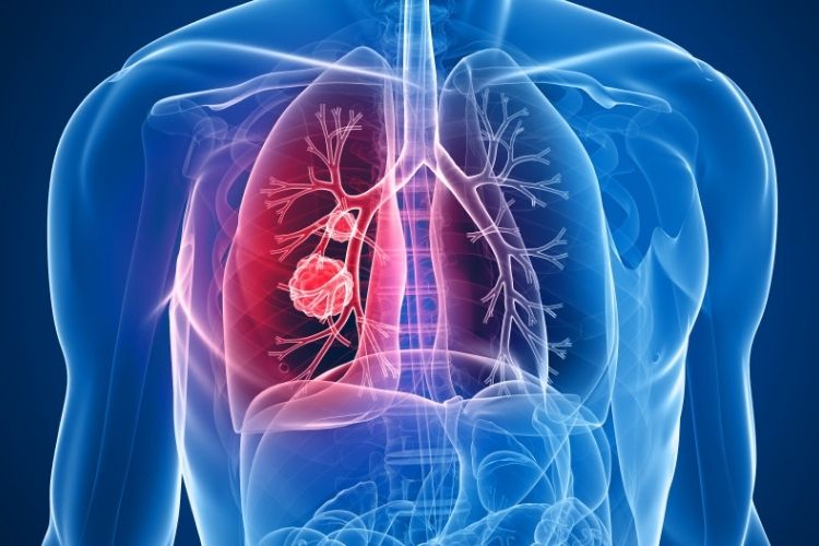 cancer du poumon